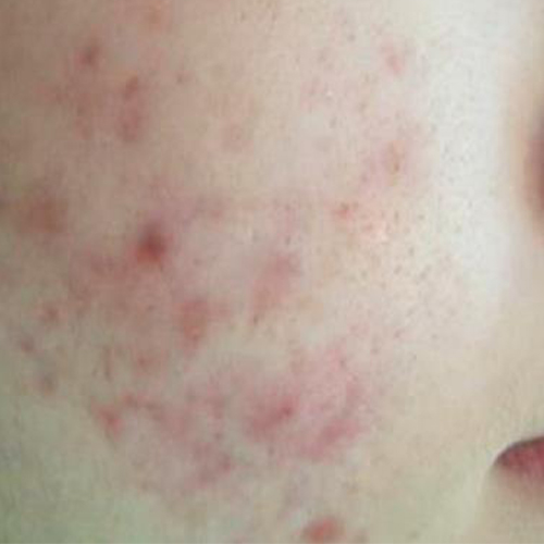 Acnee-pacient-3-A-inainte-1