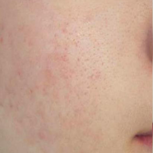 Acnee-pacient-3-dupa-o-sedinta-2