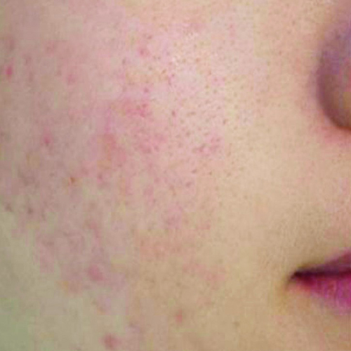 Acnee-pacient-8-dupa-2-luni-2