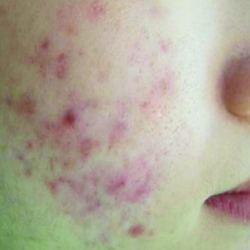 Acnee-pacient-8-inainte-1