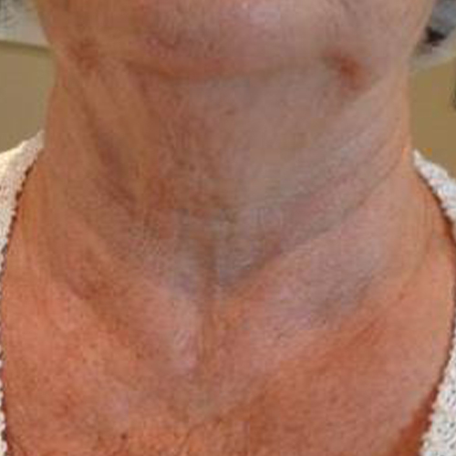 Lifting-Gat-si-Decolteu-inainte-1