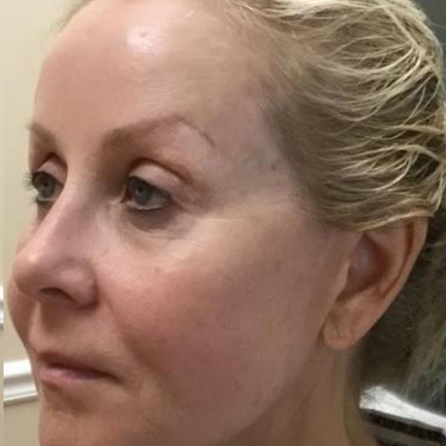 Lifting-facial-dupa-o-sedinta-2