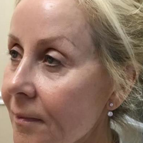 Lifting-facial-inainte-1