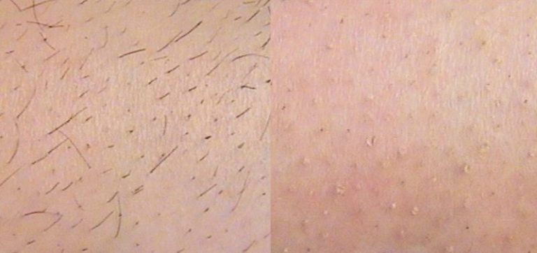 Rezultat-epilare-definitiva-laser-brasov-motus-ax-1-e1569244924715-800x377