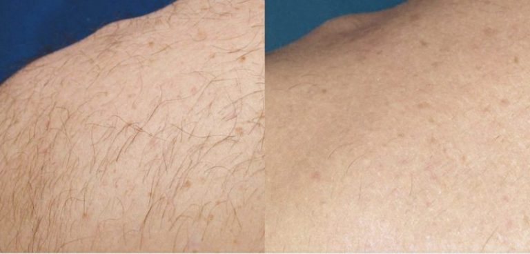 Rezultat-epilare-definitiva-laser-brasov-motus-ax-2-800x383