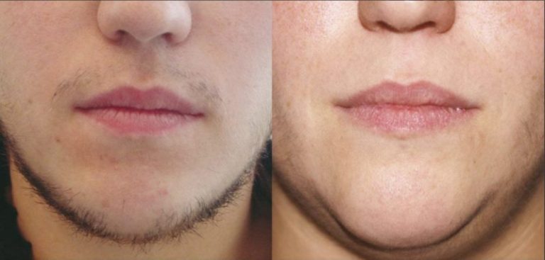 Rezultat-epilare-definitiva-laser-brasov-motus-ax-3-800x382