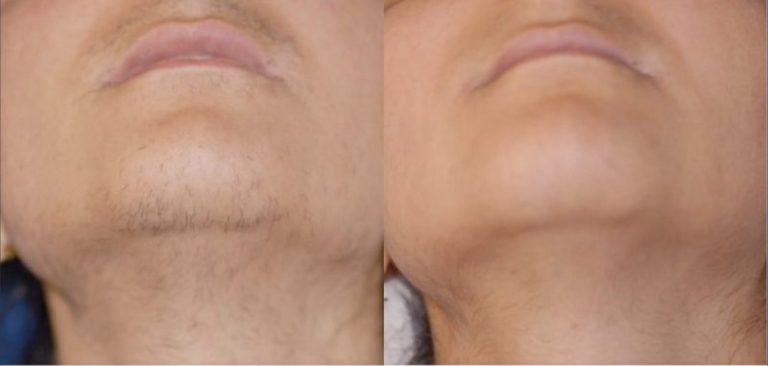 Rezultat-epilare-definitiva-laser-brasov-motus-ax-4-800x381