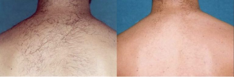 Rezultat-epilare-definitiva-laser-brasov-motus-ax-5-800x264