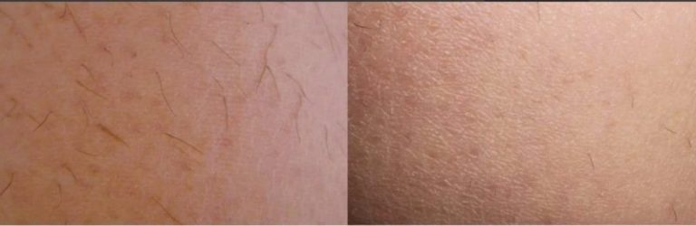 Rezultat-epilare-definitiva-laser-brasov-motus-ax-7-800x260