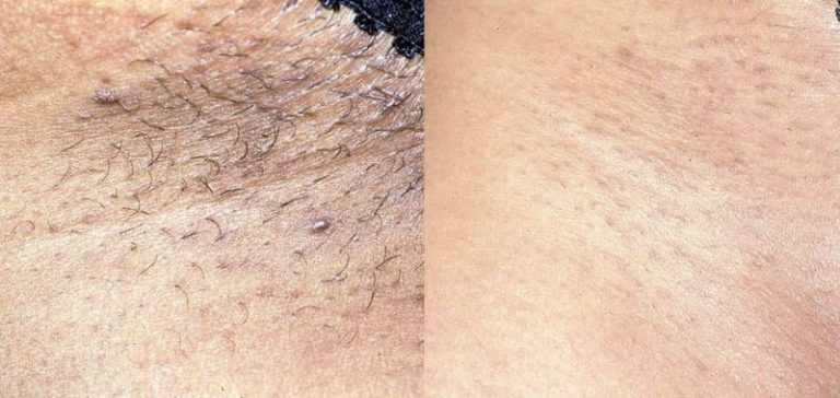 Rezultat-epilare-definitiva-laser-brasov-motus-ax-e1569244907321-800x379