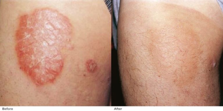 Rezultate-Inainte-si-dupa-Excilite-DEKA-Laser1