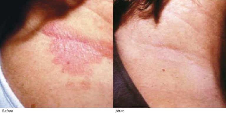 Rezultate-Inainte-si-dupa-Excilite-DEKA-Laser2