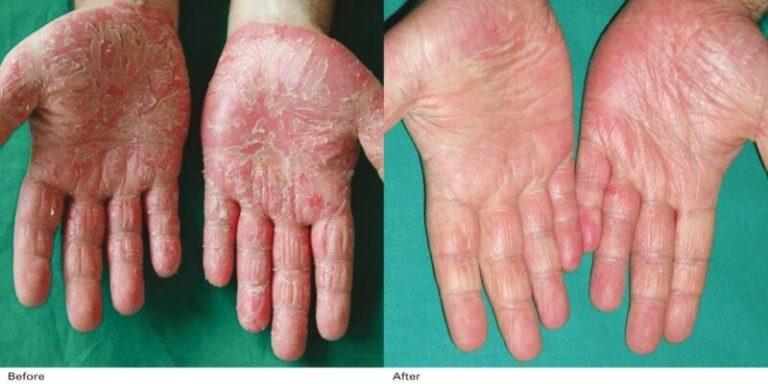 Rezultate-Inainte-si-dupa-Excilite-DEKA-Laser5