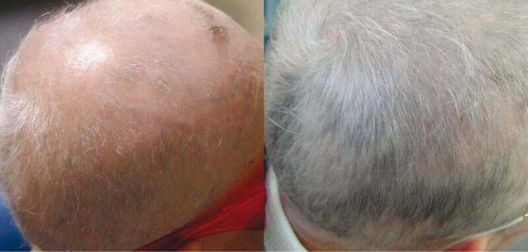 Rezultate-Inainte-si-dupa-Excilite-DEKA-Laser6