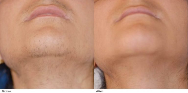 Rezultate_Inainte_si_dupa_Laser_medical_Syncro_FT__001-1-1024x510-800x398