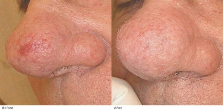Rezultate_Inainte_si_dupa_Laser_medical_Syncro_FT__002-1-1024x510-800x398