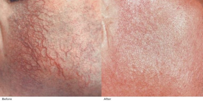 Rezultate_Inainte_si_dupa_Laser_medical_Syncro_FT__003-1-1024x510-800x398