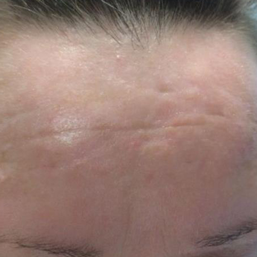 Tratament-Cicatrici-Dupa-o-sedinta-2