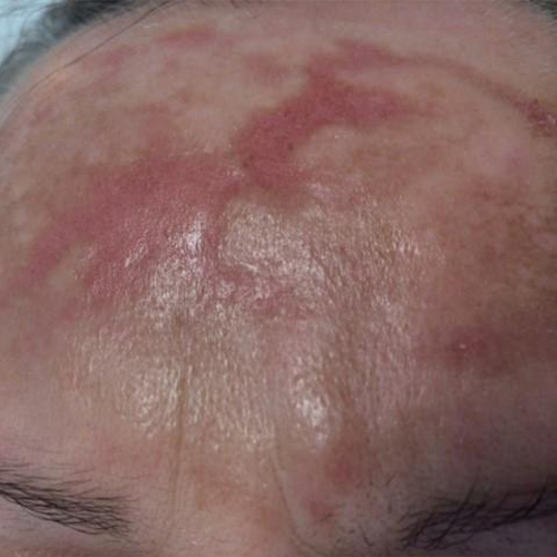 Tratament-Cicatrici-inainte-1