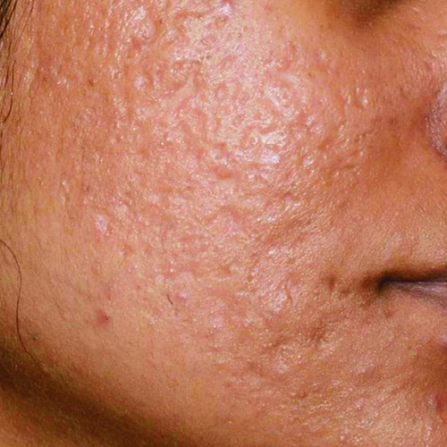 Tratament-Cicatrici-pacient-A-inainte-1