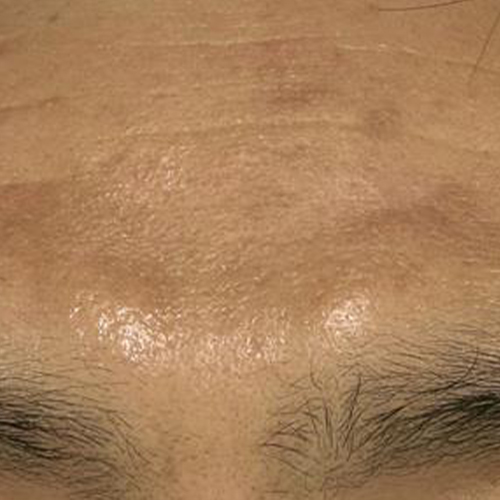 Tratament-Pigmentare-dupa-2-sedinta-2