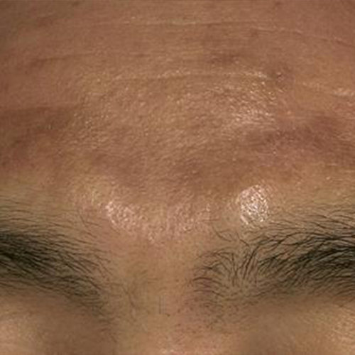 Tratament-Pigmentare-inainte-1