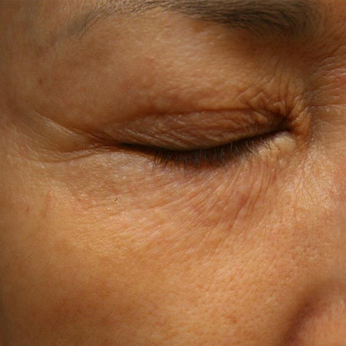 Tratament-Riduri-4-inainte-1