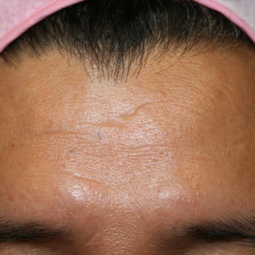 Tratament-Riduri-dupa-1-sedinta-1-2