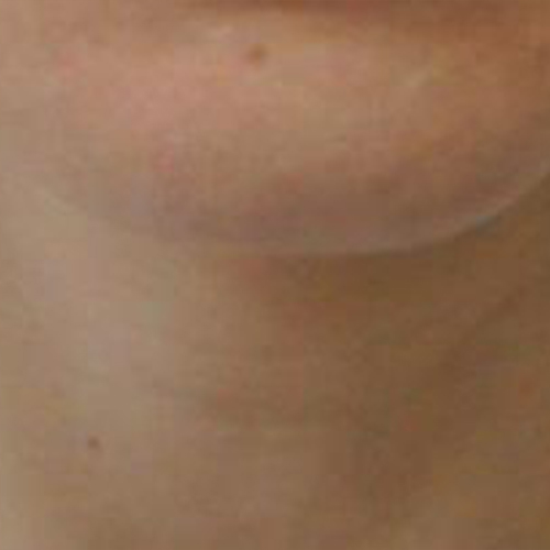 Tratament-Riduri-dupa-1-sedinta-2