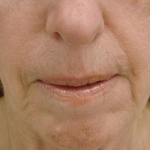 Tratament-Riduri-dupa-o-sedinta-2