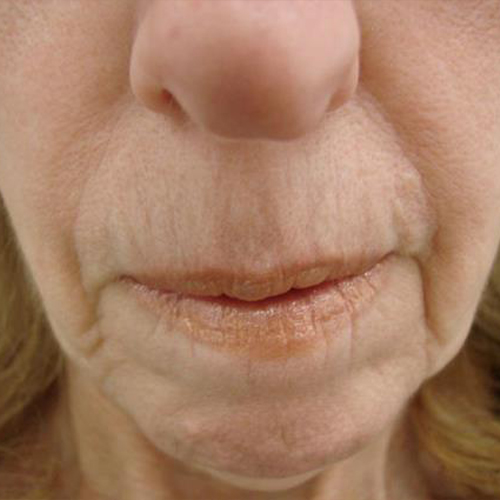 Tratament-Riduri-inainte-1-1