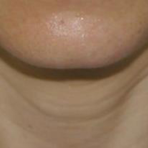 Tratament-Riduri-inainte-11