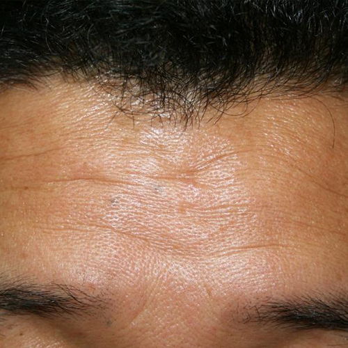 Tratament-Riduri-inainte-2-1