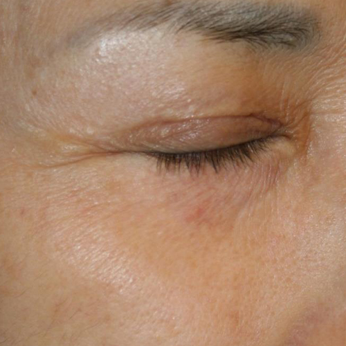 Tratament-Riduri-pacient-dupa-o-sedinta-2