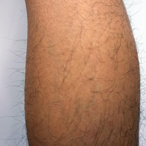 Tratament-Vergeturi-Dupa-2-tedinte-2