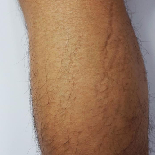 Tratament-Vergeturi-inainte-1